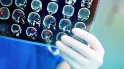 Mengenal Tumor Jinak dan Ganas: Begini Cara Membedakannya Secara Medis