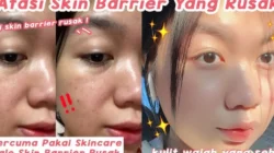 Memperbaiki Skin Barrier